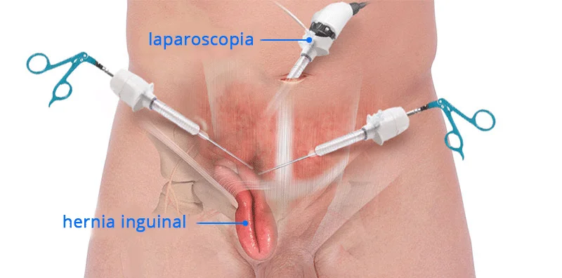 hernia-inguinal-laparoscopia