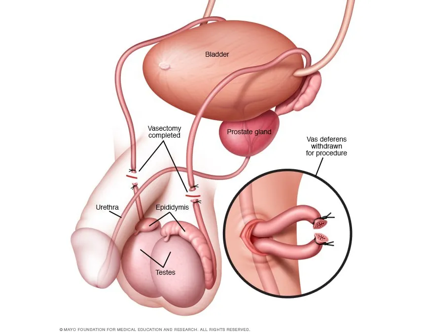 vasectomia-1